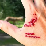 Dog bite victim documenting developing symptoms