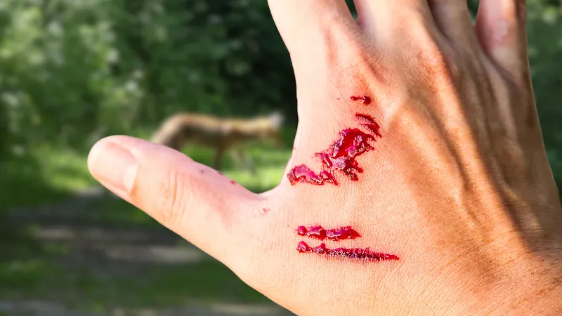 Dog bite victim documenting developing symptoms